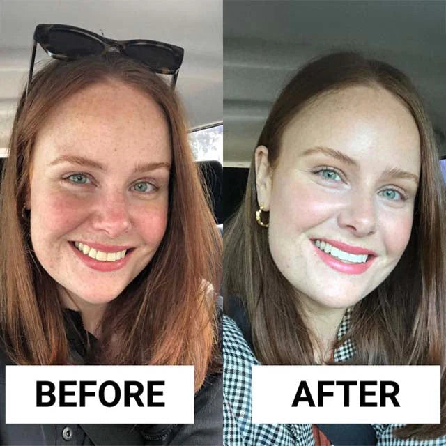 SHYNITE Strisce sbiancanti per denti